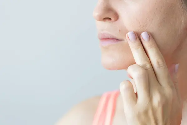Woman Mole Lip Young Woman Nasolabial Wrinkles Problem Dry Skin Stock Photo