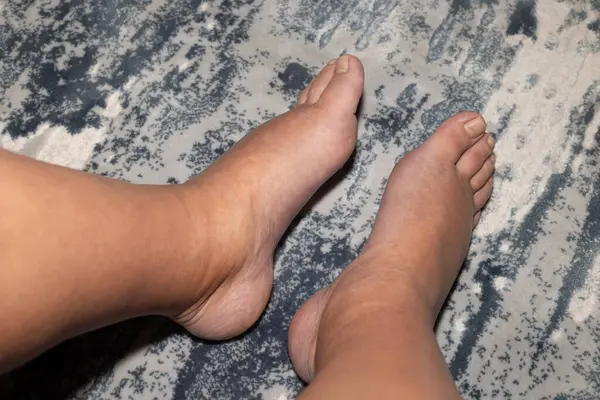 Bacağında şişlik var, yakın plan. Şişmiş kadın ayakları halının üzerinde duruyor.