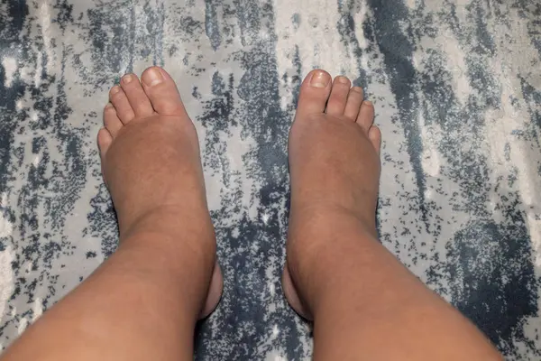 Şişmiş bacaklar, yakın plan. Şişmiş kadın ayakları halının üzerinde duruyor.