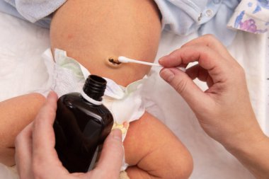 Yeni doğmuş bir bebeğin göbek bağını pamuklu bezle temizlemek, göbeğine yeni doğmuş bir bebeği tedavi etmek. Yakın çekim.