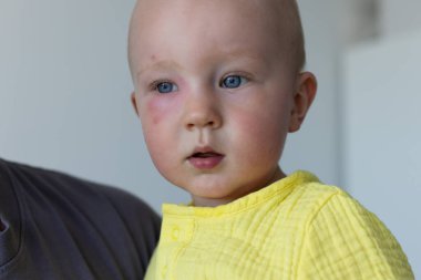 Böcek, sivrisinek ya da arı ısırığının neden olduğu yüz enfeksiyonu şişkinliğe, kızarıklığa, ısıya ve kaşıntıya neden olur. Sivrisinek ısırığından sonra alerji.. 