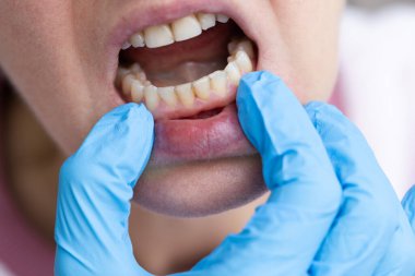 Diş hekimi diş kalkülüsü ve plakla dişleri inceliyor.