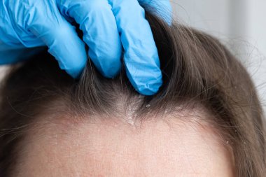 Doktor kadının kafa derisini inceliyor. Sorunlu cilt, dermatit konsepti.