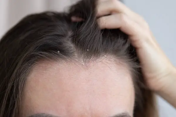 Kepekli yakın kadın saçı.