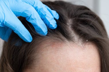 Bir dermatologla randevum var. Kadının kafasında deri iltihabı var.