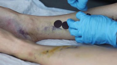 Doctor applies the stick on bandage to cover the small cuts after operation. FullHD footage