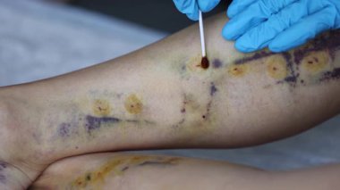 Treatment of wounds some days after innovative method of varicose veins surgery, sclerotherapy procedure. Close-up shot of patient legs. 4k footage