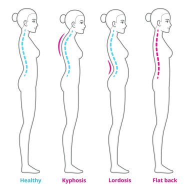 Arka duruş sorunları, tıbbi şema. Kirfoz, lordosis ve düz sırt, sağlıklı omurga karşılaştırması olan genç bir kadın. Infographic vektör illüstrasyonu.