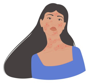 Demodyoz, sedef hastalığı olan bir kadın. Rosacea Ayın Farkındalığı illüstrasyonu. Kabuk bağlamış kadın yüzünün vektör çizimi