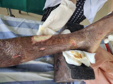 Nekrotizan fasiiti olan bir hastanın uyluğundaki büyük bir ülserin resmi. Nadir görülen bir bakteriyel enfeksiyon vücuda hızla yayılır ve ölüme neden olabilir.