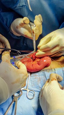 Bağırsak poliposisi sendromu olan bir hastada keşif laparotomisi ameliyatı yapan bir grup doktor.