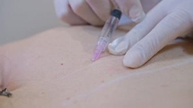Güzellik ve enjeksiyon konsepti. Klinikte kozmetoloji. Beyaz eldiven giyen deneyimli bir güzellik uzmanı, kadınlara gerekli malzemelerle deri altı enjeksiyonları yapar.
