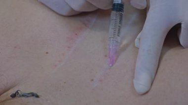 Güzellik ve enjeksiyon konsepti. Klinikte kozmetoloji. Beyaz eldiven giyen deneyimli bir güzellik uzmanı, kadınlara gerekli malzemelerle deri altı enjeksiyonları yapar.