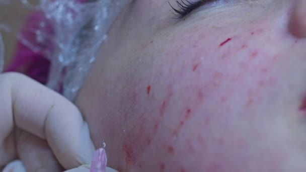 Krása Vstřikování Kosmetika Klinice Zkušený Kosmetik Bílých Rukavicích Aplikuje Subkutánní — Stock video