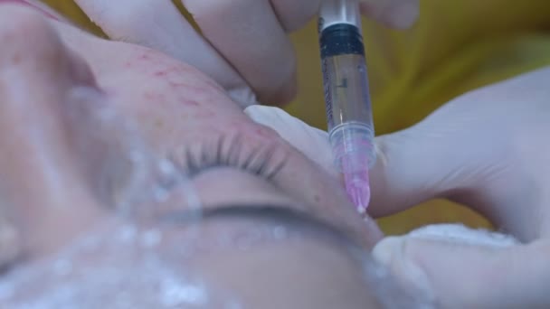 Concepto Belleza Inyección Cosmetología Clínica Esteticista Experimentado Que Usa Guantes — Vídeos de Stock