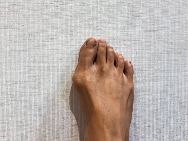 Orta yaşlı Güneydoğu Asyalı kadının ayaklarında nasır var. Varus valgus ve Hallux valgus, anormal ayak durumu. Yakın çekim..