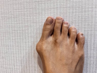 Orta yaşlı Güneydoğu Asyalı kadının ayaklarında nasır var. Varus valgus ve Hallux valgus, anormal ayak durumu. Yakın çekim..