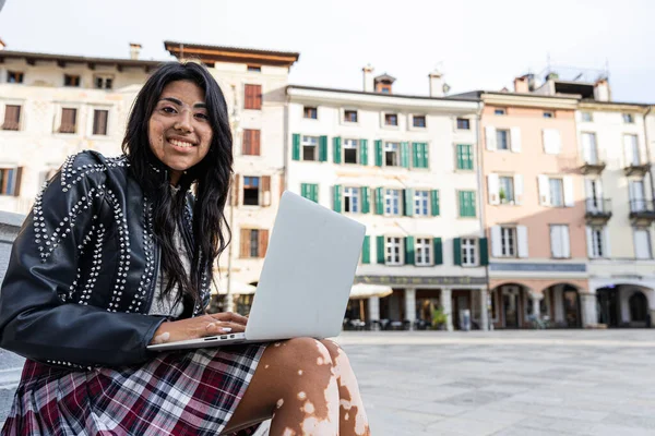 A young latina girl with vitiligo uses her laptop while sitting in the city center