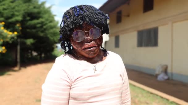 Portret Afrykańskiej Kobiety Ofiary Oparzeń Skóry — Wideo stockowe