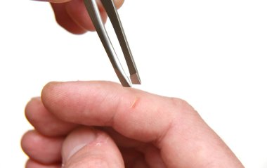 Bir parmaktan metal cımbızla kıymık almak, makro yakın çekim fotoğraf. 