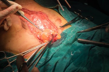 Ameliyat odasında abdominal cerrahi