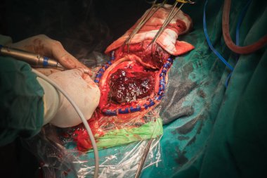 Ameliyat odasında beyin ameliyatı.