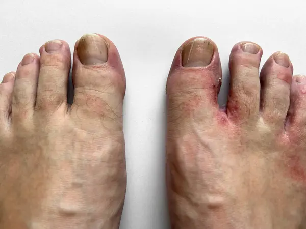 Feet with signs of skin infection between the toes. infections that get under the skin, through a fungal disease