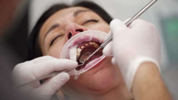 ジルコニアベニヤの設置手順を有する女性患者のクローズアップショット 現代歯科クリニックに女性の歯に白いベニヤを設置します 歯科セラミッククラウンを設置するプロセス — ストック動画