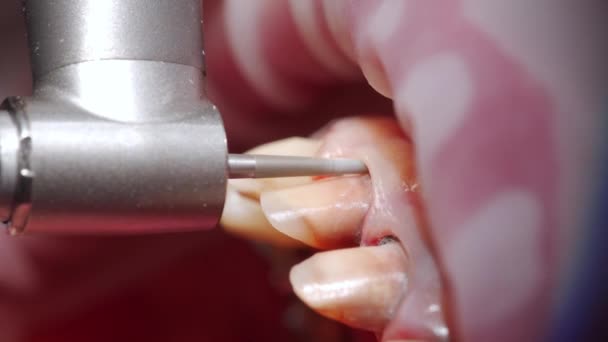 ジルコニアベニヤをインストールする前に歯のエナメルを除去するためのクローズアップマクロショット 歯科セラミッククラウンを取り付けるために女性の歯を準備する歯科医 コスメティック歯科 — ストック動画