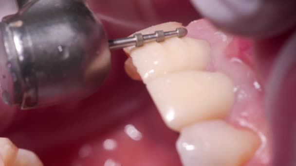 Close Tiro Remover Parcialmente Esmalte Dentes Por Bur Diamante Dental — Vídeo de Stock