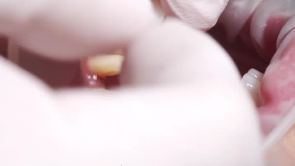 セラミッククラウンを女性患者に設置したクローズアップマクロショット 現代の歯科医院にジルコニアのベニヤを取付けるプロセス 磁器のベニヤの設置プロシージャの間に患者 — ストック動画
