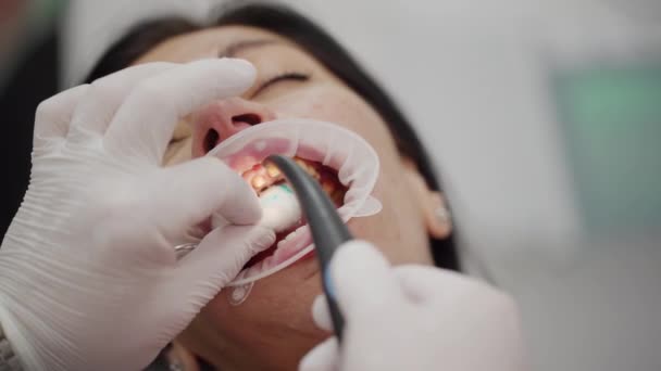 准备女病人的牙齿 以粘合瓷冠 在安装氧化锆毒液之前 先喷涂和清洁牙齿 牙医从妇女的牙齿上洗掉蓝色酸 后续行动 — 图库视频影像