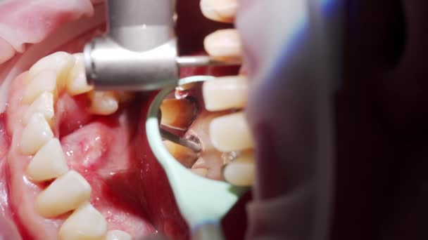 ジルコニアベニヤを取付けるための女性の歯を準備するためのクローズアップマクロショット ミラーを使用して歯科用エナメルを除去し セラミッククラウンを設置する前に歯科用エナメルを除去します コスメティック歯科 — ストック動画