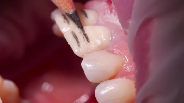 歯科セラミックベニヤの準備 鉛筆によるセラミック空間の厚さのための深さ切断のマクロショット 陶磁器のベニヤおよび冠の取付けのための歯を準備する歯科医 — ストック動画