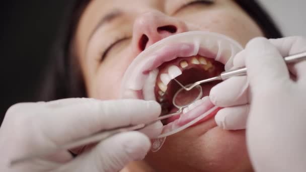 ジルコニアベニヤを取付けるプロセス 歯科医院の女性の歯のベニヤ 磁器の冠を結ぶための紫外線ライトを使用する歯科医 紫外線ランプを使用してベニヤを結合します クローズアップ — ストック動画