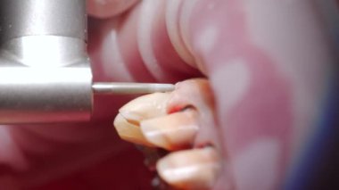 Zirkon kaplamaları yerleştirmeden önce diş minelerini tek tek sökerken yakın çekim makro çekim. Dişçi, dişçi dişlerini diş seramik kaplamaları için hazırlıyor. Kozmetik dişçiliği.