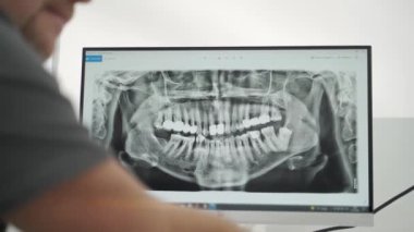 Ekranda çenelerin panoramik röntgeni var. Erkek dişçi, diş kliniğindeki kadın hastaya bilgisayar ekranında çene röntgeni gösteriyor. Ortodontist diş röntgenini açıklıyor. Ağız cerrahıyla görüşmeler.