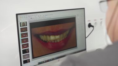 Kadın hastaların diş tebessümlerinin fotoğrafı ekranda. Kozmetik dişçisi modern diş kliniğindeki hasta modellik kaplamalarını açıklıyor. Doktor hastaya diş fotoğrafını gösteriyor. Yakın plan..
