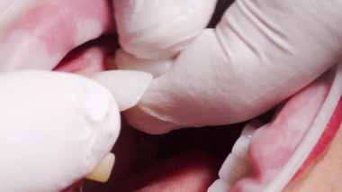 Kadın hastaya dişsel seramik kaplama takarken yakın plan makro çekim. Modern dişçilik kliniğine zirkon kaplaması yerleştirme işlemi. Porselen kaplama kurulum işlemi sırasında hasta.