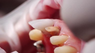 Kadın hastaya seramik taç takarken yakın çekim makro çekim. Modern diş kliniğine zirkon kaplaması yerleştirme işlemi. Porselen kaplama kurulum işlemi sırasında hasta.