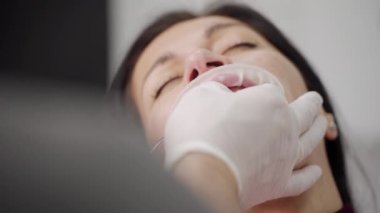 Zirkon kaplamaları yerleştirme işlemi. Diş hekimlerinin elleri kaplama için ultraviyole ışık kullanıyor. Diş kliniğinde kadın dişlerine porselen kaplamalar takıyor. Ultraviyole lamba kullanarak kaplamaları bağlamak. Yakın plan..