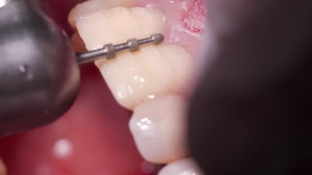歯科ダイヤモンドバーで部分的に歯のエナメルを除去するクローズアップショット 歯科バーを使用してジルコニアベニヤと王冠をインストールするための女性の歯を準備する歯科医 義肢のコンセプト — ストック動画