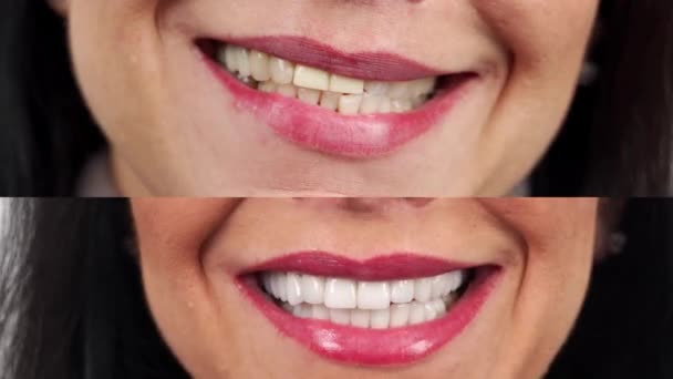 Close Mulheres Sorrir Antes Depois Folheados Zircônia Coroas Cerâmica Dental — Vídeo de Stock