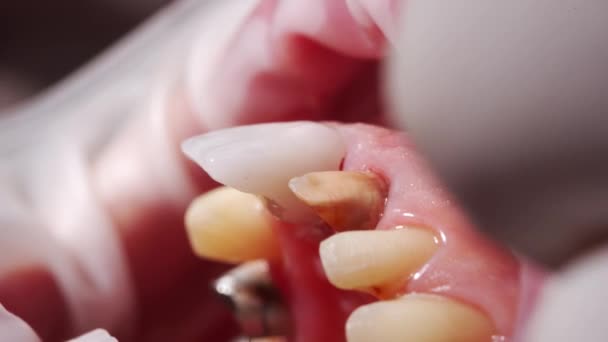 セラミッククラウンを女性患者に設置したクローズアップマクロショット 現代の歯科医院にジルコニアのベニヤを取付けるプロセス 磁器のベニヤの設置プロシージャの間に患者 — ストック動画