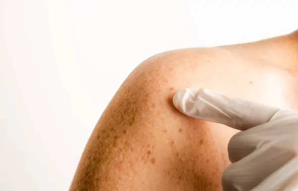 Doctor with white glove pointing at shoulder of white woman with nevus, moles, spots on the skin, isolated white background. Skin diseases. Insolation. Sun spots. Close up. Dermatology. Skin cancer. Real people.