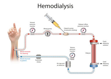 Hemodiyaliz ya da diyaliz böbrekleri normal çalışmayan bir insanın kanını arıtma sürecidir.