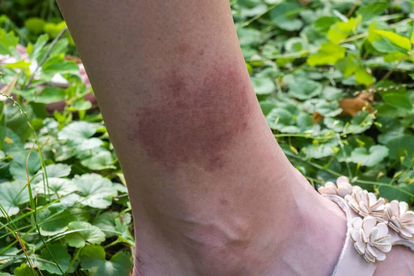 Kene ısırığından sonra bacağında büyük kırmızı bir leke var, Lyme hastalığı. Yüksek kalite fotoğraf
