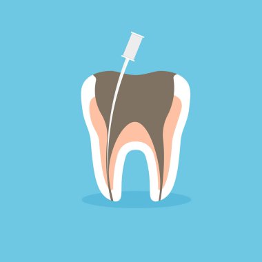 Endodontik kök temizliği ve bakım işlemleri. Diş sağlığı. Modaya uygun düz bir şekilde vektör illüstrasyonu.