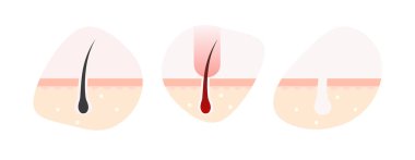 Lazer tüy temizleme adımları. Lazer epilasyon bilgileri. İnsan derisi ve saç kökleri. Vektör illüstrasyonu.