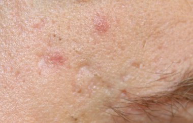 Vücutta sivilceli bir cilt sorunu var. İnsan deri dokusunu en iyi kalitede stokla. Yara izli fotoğraf..